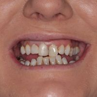 Composite Bonding - Smile 4 before